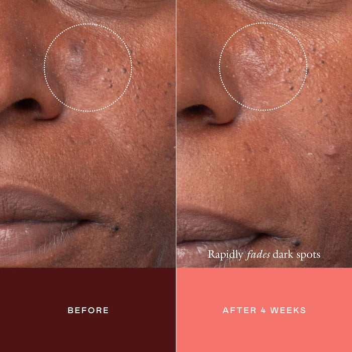 EADEM The Mark Advanced Targeted Dark Spot Concentrate with 5% Tranexamic Acid, 1% Alpha Arbutin & 1% Kojic Acid for Hyperpigmentation, Acne Marks & Age Spots