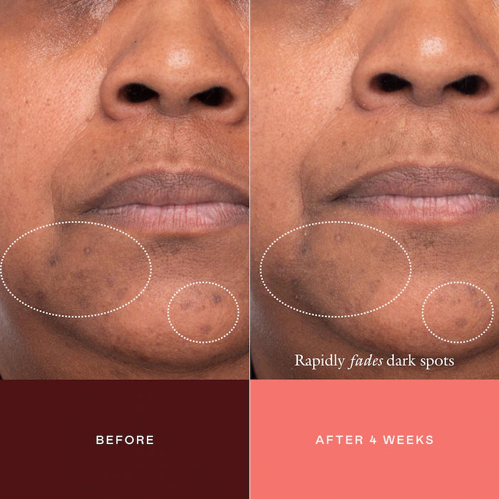 EADEM The Mark Advanced Targeted Dark Spot Concentrate with 5% Tranexamic Acid, 1% Alpha Arbutin & 1% Kojic Acid for Hyperpigmentation, Acne Marks & Age Spots