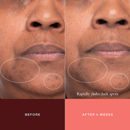 EADEM The Mark Advanced Targeted Dark Spot Concentrate with 5% Tranexamic Acid, 1% Alpha Arbutin & 1% Kojic Acid for Hyperpigmentation, Acne Marks & Age Spots